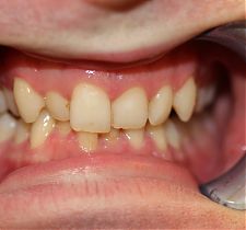 Six Month Smiles Before