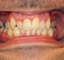 Six Month Smiles Before