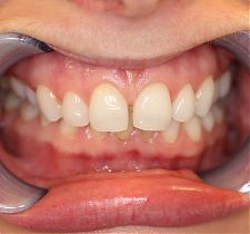 Six Month Smiles Before