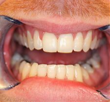 Six Month Smiles After