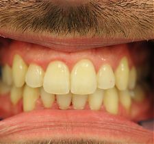 Six Month Smiles After