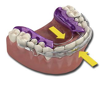 Now Doing Inman Alinger Braces system.