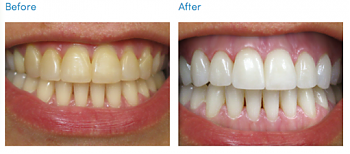 WIN free bleaching at Cork Dental Care